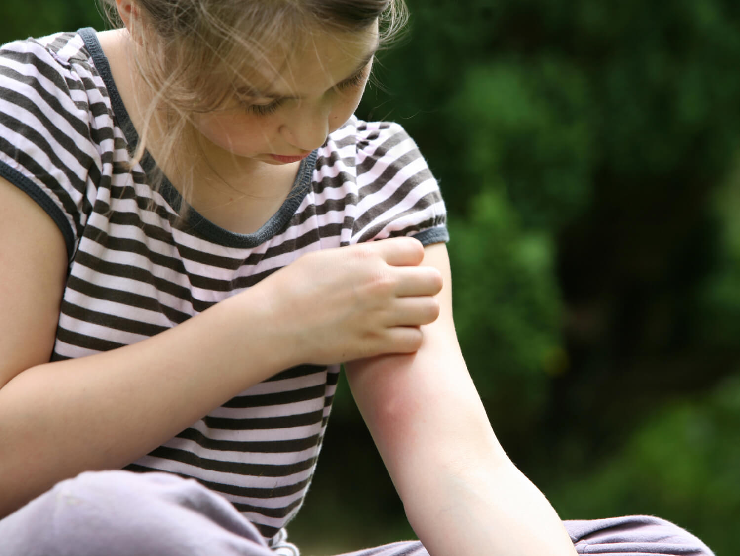 child with mosquito bite